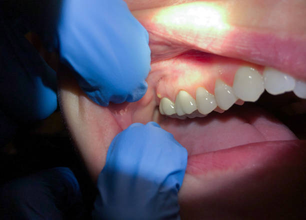 Best Emergency Treatment for Oral Infections in Iowa Falls, IA