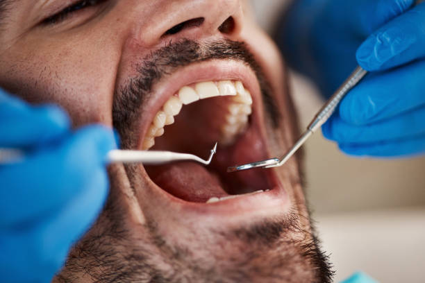 Best Emergency Wisdom Tooth Extraction in Iowa Falls, IA